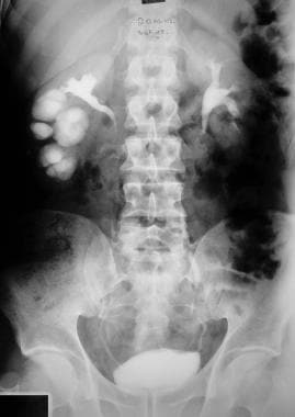 Excretory urography in a patient with a duplex rig
