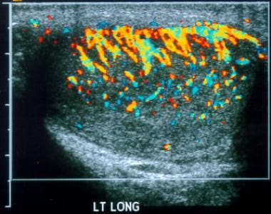 Testicular torsion. Epididymo-orchitis. Longitudin