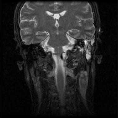 Coronal T2-weighted MRI shows a left-sided cervica