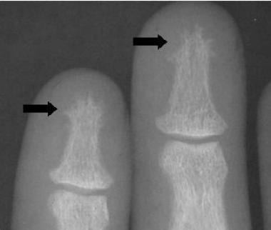 Radiograph of the phalanges in a patient with prim