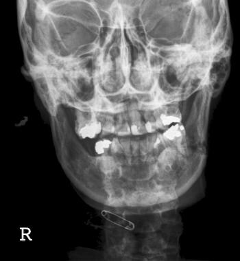 Posteroanterior radiographic view showing a left a