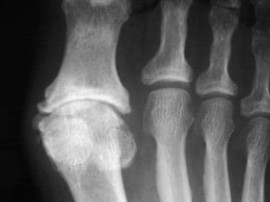 Radiograph of the foot reveals narrowing, subchond
