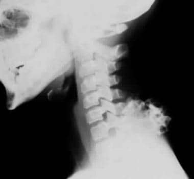 Plain radiograph of the cervical spine shows a sol