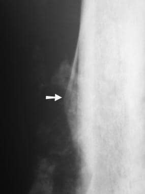 Radiograph of the femur in a patient with osteosar