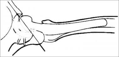 Illustration of an anteversion of an acetabular co