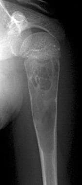 Frontal radiograph in a 10-year-old boy with pain 