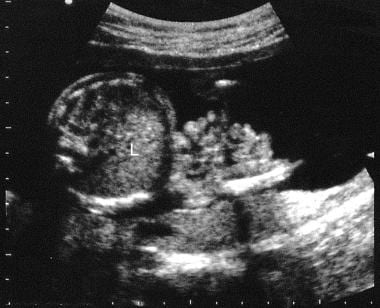 Axial sonogram through the mid abdomen of a fetus.