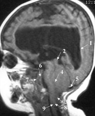 Sagittal T1-weighted magnetic resonance image of p