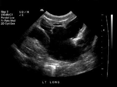 Renal sonogram (same patient as in the previous 4 