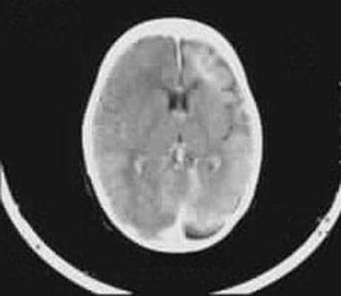 Contrast-enhanced CT scan shows intense enhancemen