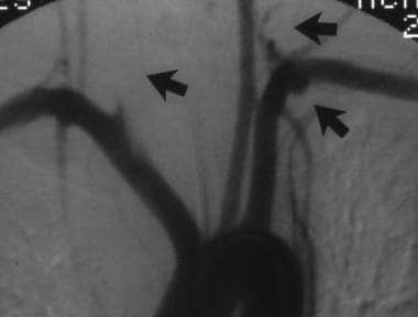 Aorta, trauma. Posteroanterior angiogram shows mul