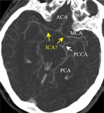 一例双侧动脉瘤患者的颅内CT血管造影