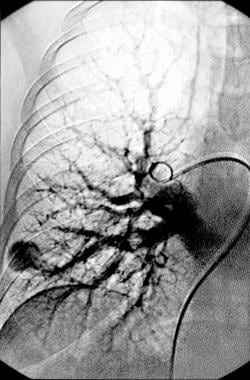 Pulmonary angiography. Venous phase of a right pul