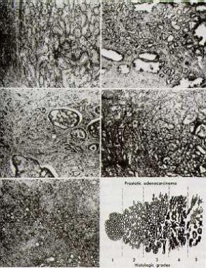 Histologic scoring system (the Gleason scoring sys