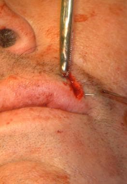 Placement of the first suture through the vermilio