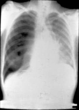 Tension pneumothorax of the right lung after blunt