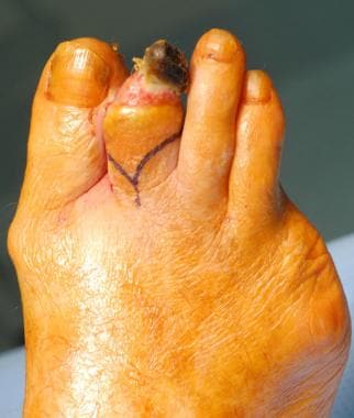 Markup for second-toe amputation (fish-mouth skin 