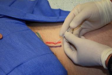 Femoral artery cannulation (catheter over needle).