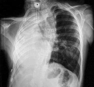 A chest radiograph of a 14-year-old child with pri