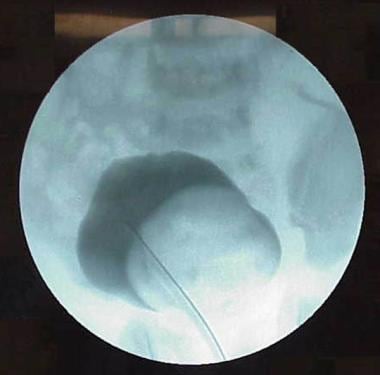 A large ureterocele is seen as a filling defect on