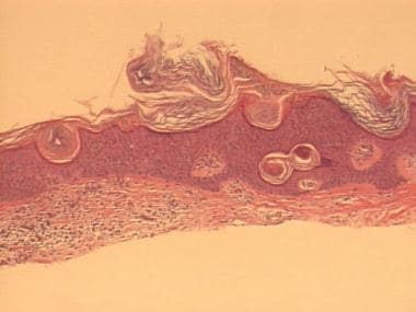 Seborrheic keratosis with inflammation in the derm