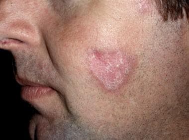 Discoid lupus erythematosus on the face. 