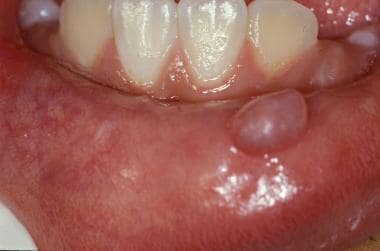 Classic example of a mucocele in a child. The fluc