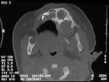 Axial CT, bone window, noncontrasted scan demonstr