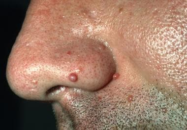 A 27-year-old man has telangiectatic, red papules 