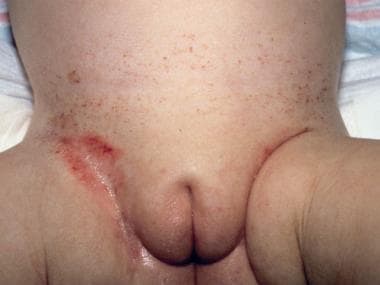 Letterer-Siwe disease. Bilateral inguinal erosive 