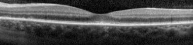 Spectral-domain optical coherence tomography (SD-O