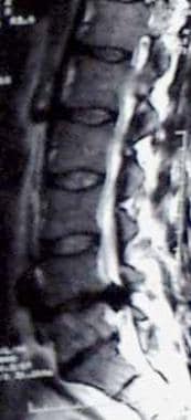 Sagittal MRI of a patient with cauda equina syndro