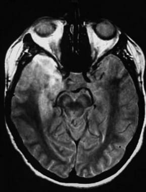 Axial proton density-weighted image in 62-year-old