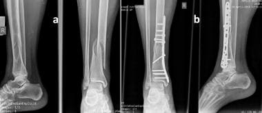 Diaphyseal tibial fracture. Preoperative (a) and p
