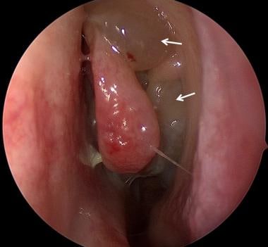 Bilateral sale nasal polypectomy