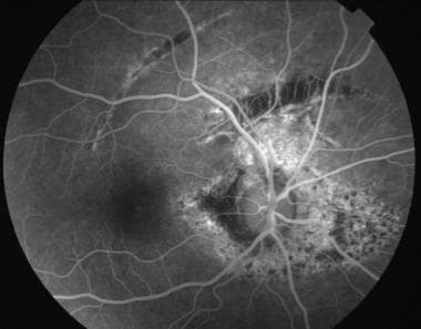 Mid-phase fluorescein angiogram in a 23-year-old m