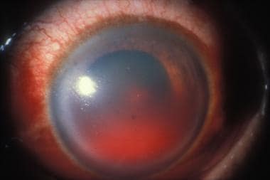 Hyphema - Blood in anterior chamber resulting from