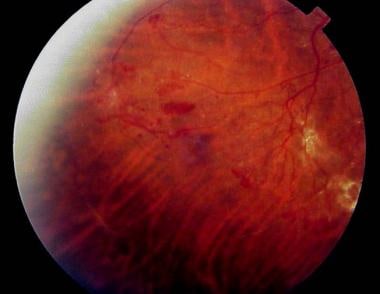 New vessel formation on the surface of the retina 