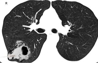 Lung Abscess Surgery Workup: Approach Considerations, Laboratory ...