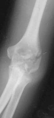 Anteroposterior radiograph following a distal hume
