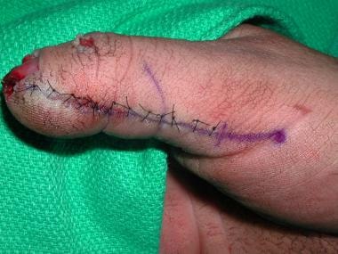 Radial view of the closure of a thumb defect with 