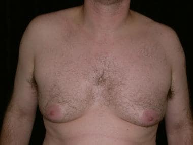 Forty-eight-year-old male gynecomastia patient wit