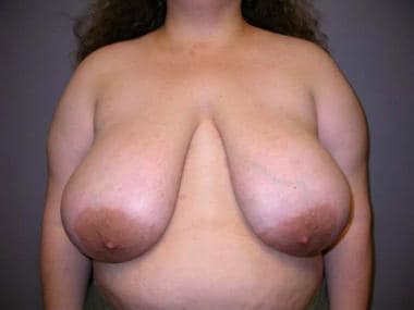 Preoperative photograph of the breasts of patient 