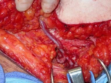 Superficial inferior epigastric vessels dissected 