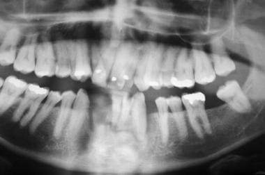 Mandibular sagittal symphysis fracture and dentoal