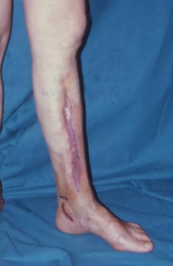 Clinical Case 4. Osteomyelitis of the middle third