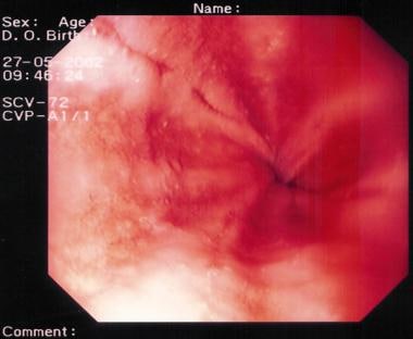 Esophagitis Workup: Approach Considerations, Laboratory 