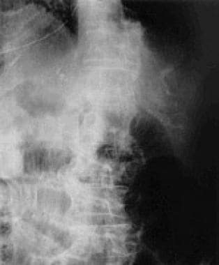 Pneumatosis intestinalis, one of few radiographic 