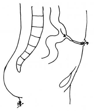 Congenital patent omphalomesenteric duct resulting