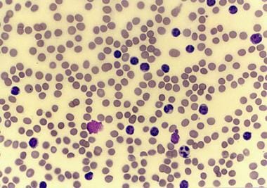 Peripheral smear from a patient with chronic lymph